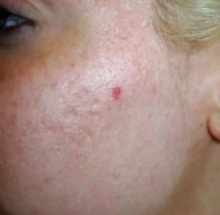 Actual Acne Scarring Patient After Treatment