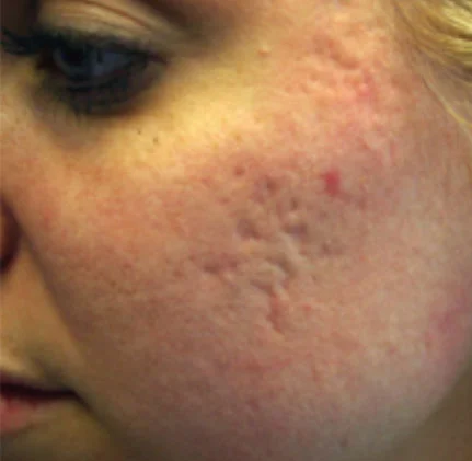 Actual Acne Scarring Patient Before Treatment