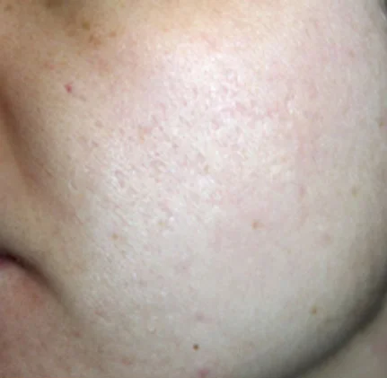Actual Acne Scarring Patient After Treatment