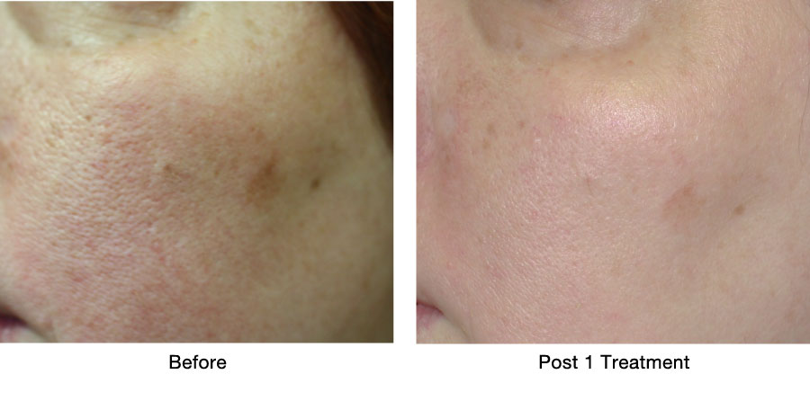Skin Resurfacing