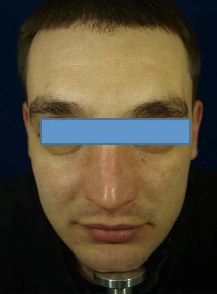 Actual Laser for Pigmentaion Patient After Treatment