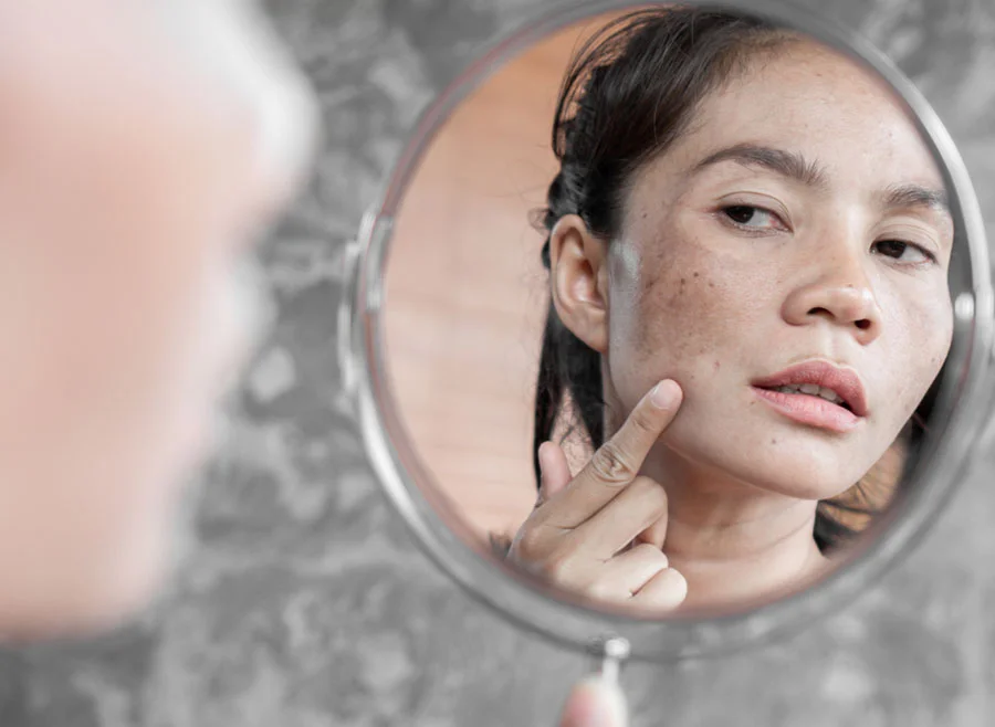What is Laser for Pigmentation?