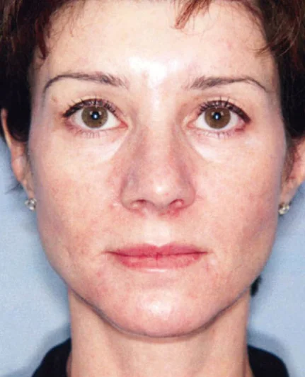 Actual Photo Rejuvenation Patient After Treatment