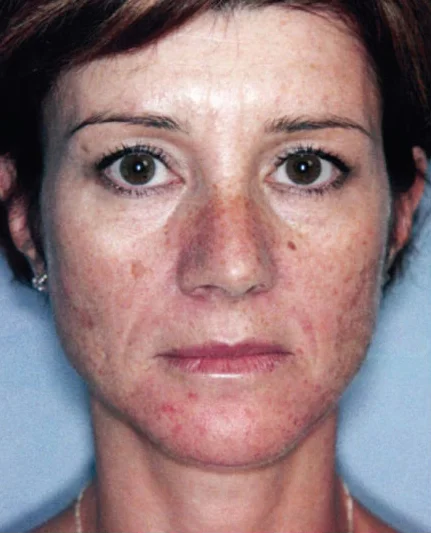 Actual Photo Rejuvenation Patient Before Treatment