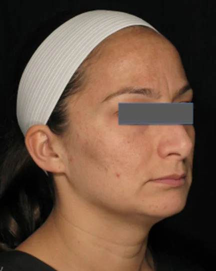 Actual Skin Resurfacing Patient After Treatment