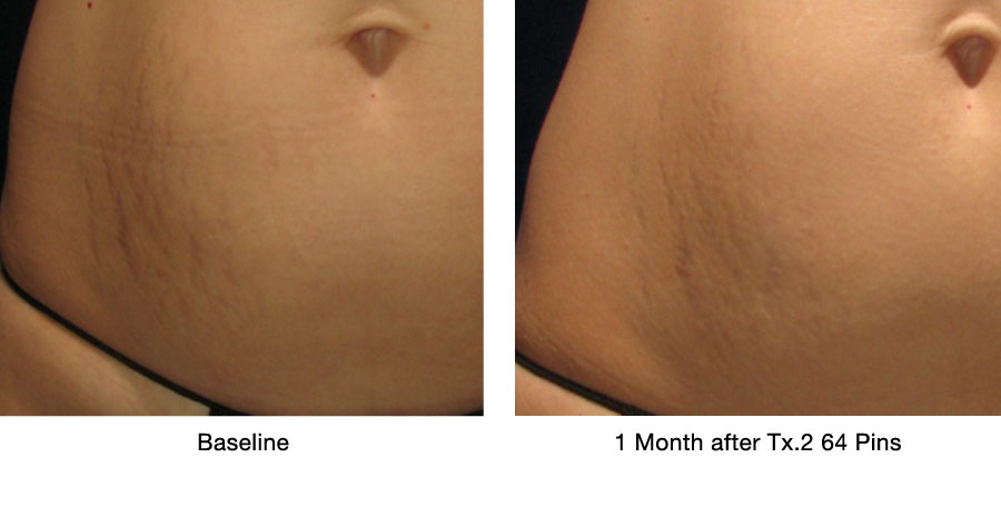 Stretch Marks